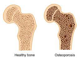 osteoporosis profile